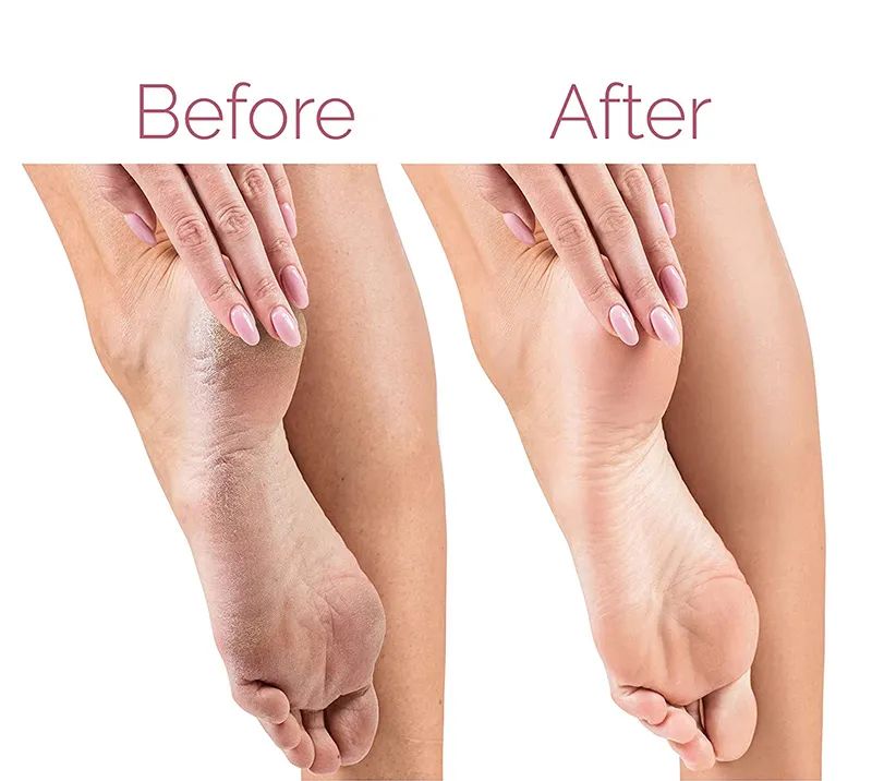 Rechargeable Foot File for Heels Grinding