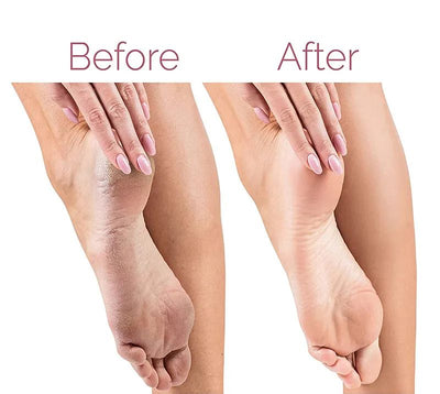 Rechargeable Foot File for Heels Grinding